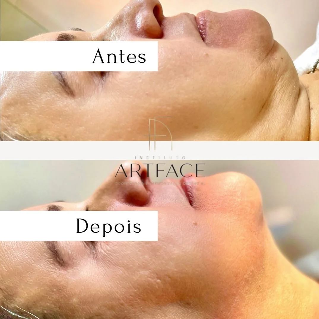 Lipoaspiração de Papada e definição do contorno cervical no Instituto ArtFace